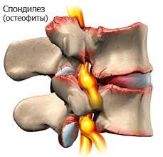 Деформирующий спондилез