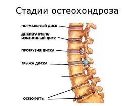 Остеохондроз