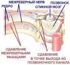 Межреберная невралгия